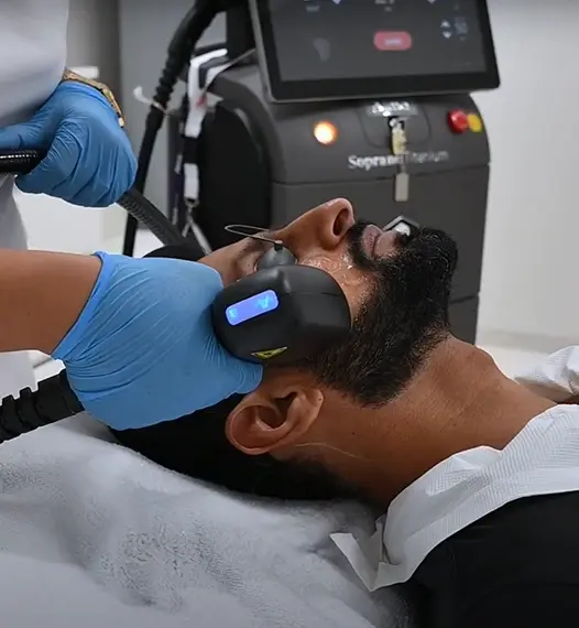 Male Beardline Laser Treatment