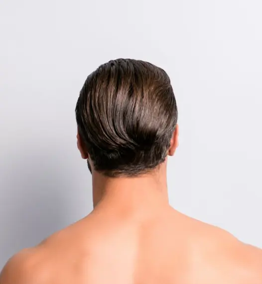 Male Back of Neckline Laser Treatment Model