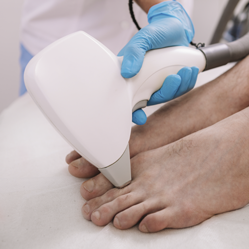 Feet Laser Treatment Model